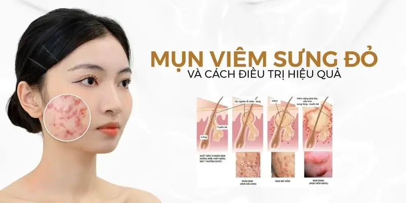 Nguyên nhân gây mụn viêm bạn cần biết