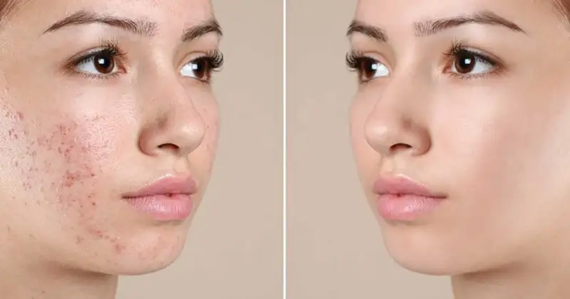 Kinh nghiệm điều trị mụn viêm từ người dùng