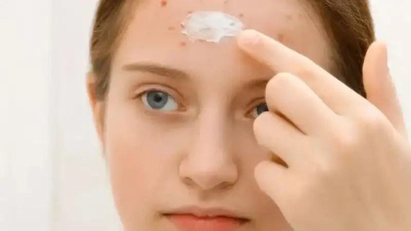 Kinh nghiệm trị mụn cho trẻ 10 tuổi tại nhà từ chuyên gia