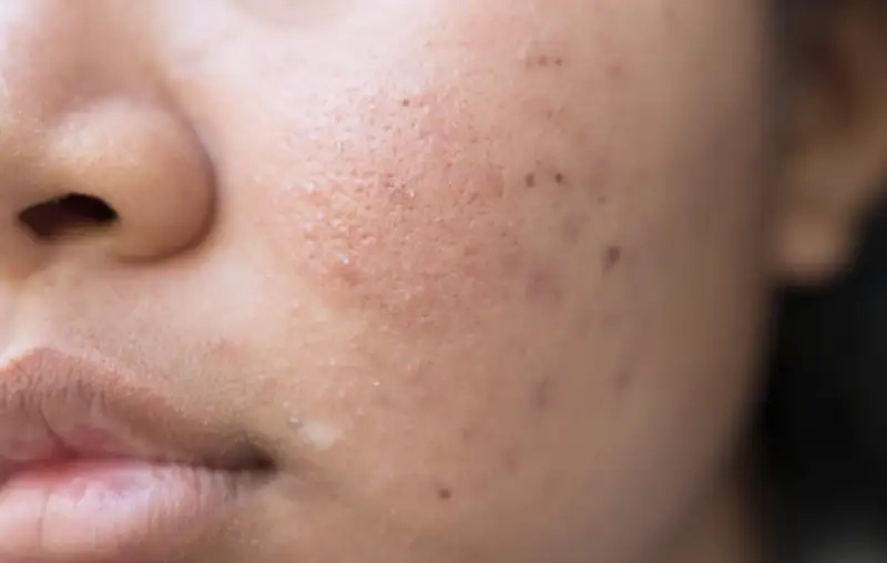 Các bước chăm sóc da giúp trị mụn tại nhà