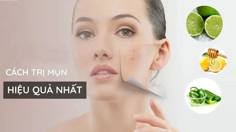 Nguyên nhân gây mụn và cách phòng tránh
