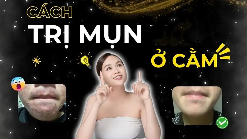 Nguyên nhân gây mụn ở cằm và cách phòng tránh
