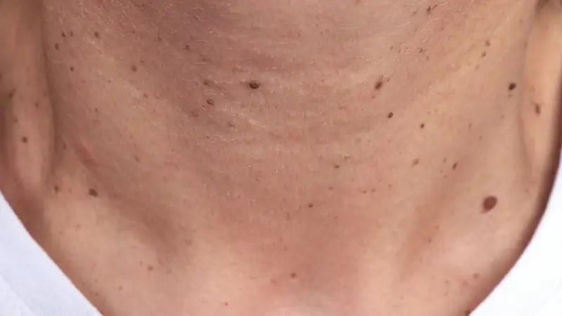 Vì sao cổ lại dễ nổi mụn đến vậy?