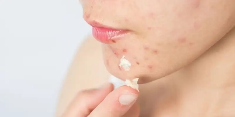 Chăm sóc môi hàng ngày giúp ngăn mụn quay lại