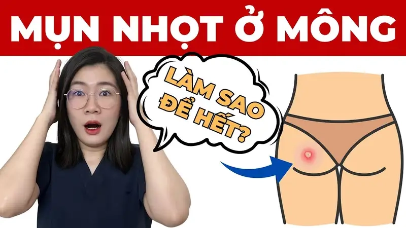 Nguyên nhân gây ra mụn ở mông