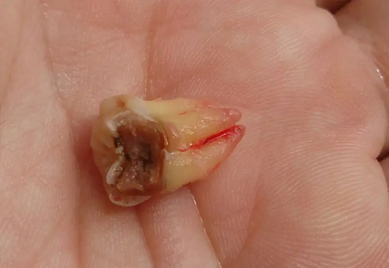 Kinh nghiệm chăm sóc răng số 8 sau khi mọc