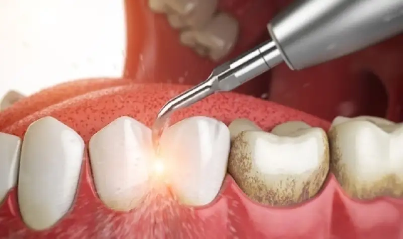 Tần suất hợp lý để bảo vệ răng miệng