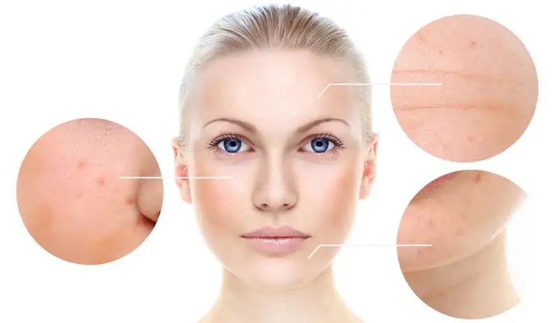 Ai nên thận trọng khi peel da