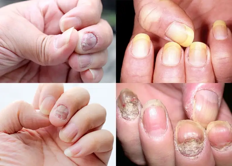 Ảnh hưởng đến móng và da quanh móng