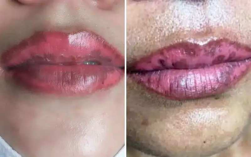 Nguy cơ biến chứng và rủi ro tiềm ẩn