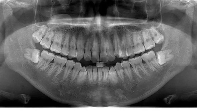 Giải đáp khi nào nên nhổ răng khôn