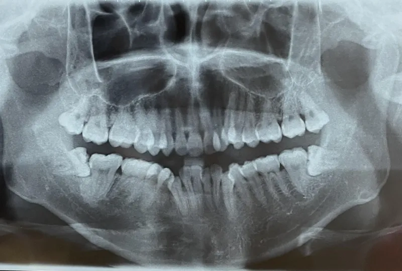 Nhổ răng khôn ảnh hưởng thần kinh không