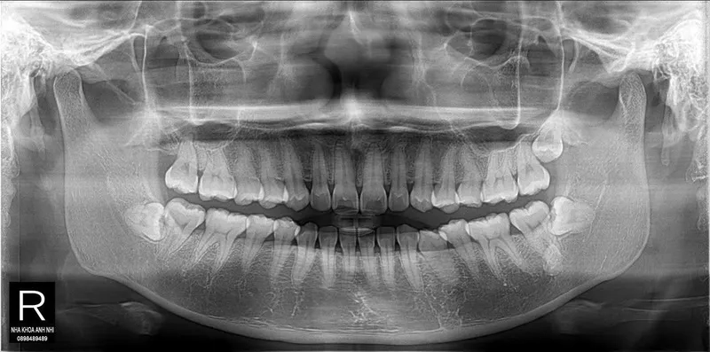 Tìm hiểu thực tế răng khôn là gì