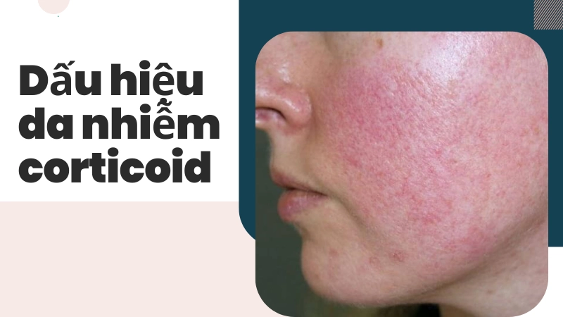 Dấu hiệu nhận biết da bị nhiễm Corticoid do dùng kem lột
